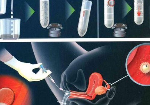 泰國試管嬰兒流程步驟？