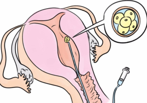 美國做試管嬰兒費用？?